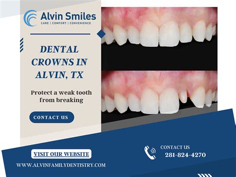 crown dental alvin